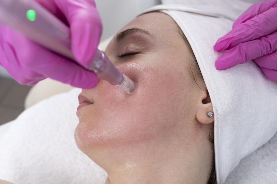 Microneedling