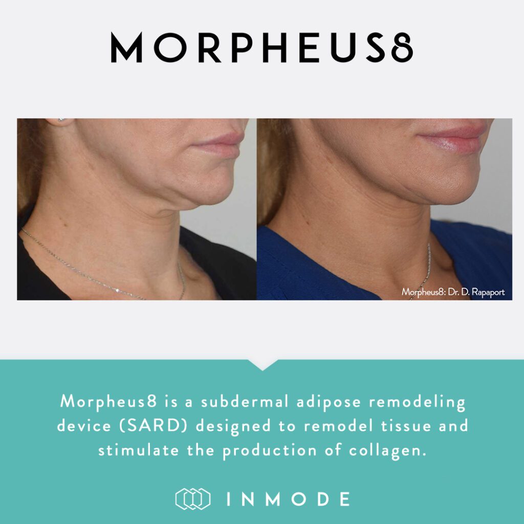 Morpheus8 treatment results on a woman's double chin.
